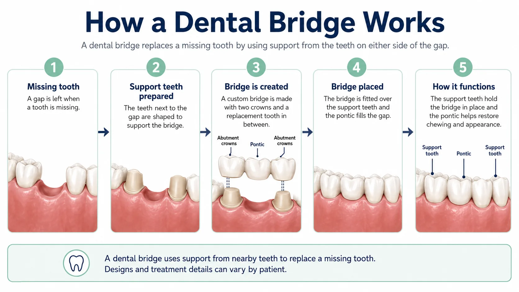 Five-step infographic showing a missing tooth, preparation of support teeth, creation and placement of a dental bridge, and how the bridge functions.